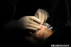 关于面部线雕，医生告诉您6个"事实"图片