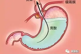 胃食管反流病的预防和日常保健图片