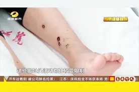 小毛病不容忽视！腿上脓包自行涂药治疗，症状加剧确诊急性肾炎视频封面