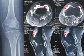 骨科大夫揭秘：跑步后腿疼、脚疼到底怎么回事？图片