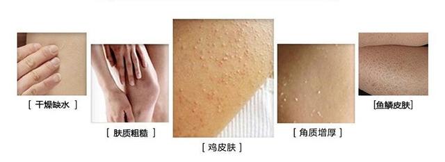 胳膊和腿上长一片一片的鸡皮疙瘩