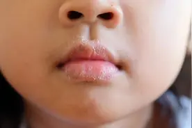 天气干燥，宝宝皮肤容易起皮，快试试这四招护理方法图片