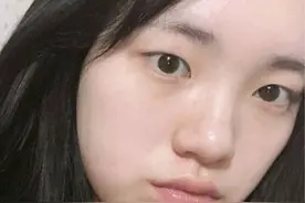 90后女孩感叹鼻子太丑，记录自己隆鼻恢复过程，前后效果对比图片