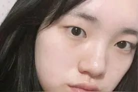 90后女孩感叹鼻子太丑，记录自己隆鼻恢复过程，前后效果对比图片