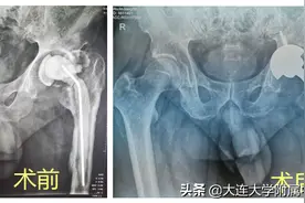 【案例回放】治疗髋关节置换术后假体周围感染有新招图片