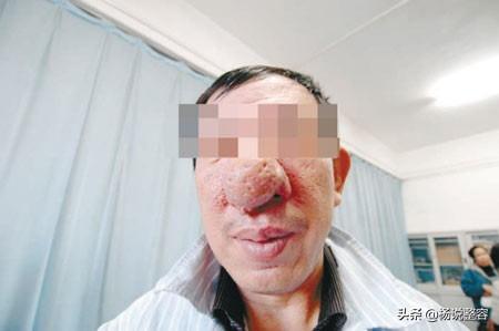 不看不知道,一看吓一跳(什么是酒糟鼻) - 冷求网