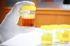 蛋白尿和尿蛋白有什么区别？尿有泡泡是肾脏生病吗？医生带您了解图片