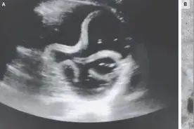 新英格兰医学杂志：一名印度男子胃部发现大量蠕动蛔虫图片