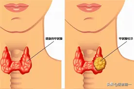 甲状腺结节离癌多远？能治愈吗？图片