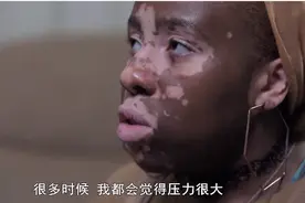 脸上长了白斑该怎么办？图片