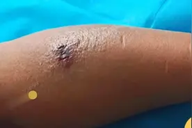 陕西男子拍吸血蚊后险遭截肢！遇到不能拍？蚊子吸血都有哪些谣言图片