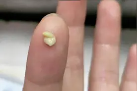 扁桃体结石｜不规则的小颗粒，非常臭，还忍不住想闻？本文说清楚图片