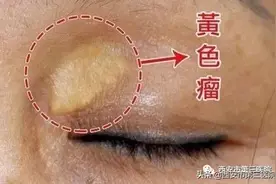 【爱美指南】睑黄瘤，您了解吗？图片