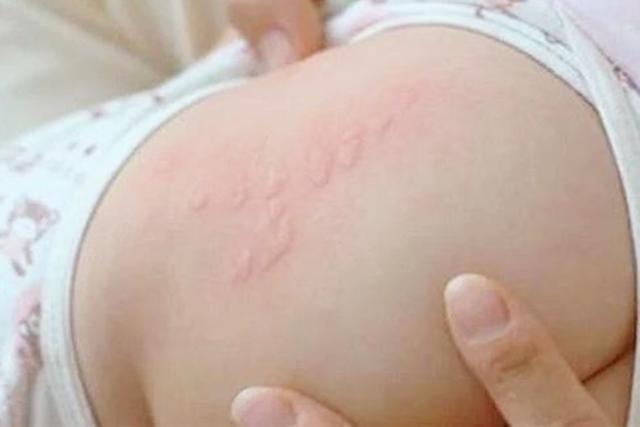 新生儿一个多月皮肤有鸡皮疙瘩