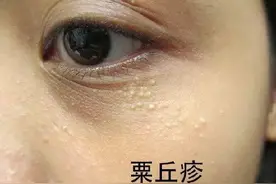 为什么眼周爱长脂肪粒，该怎么消除？图片