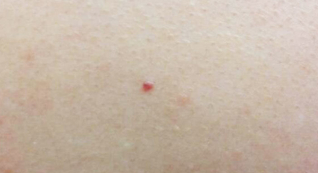 满身都是小红点