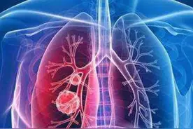 注意：“肺癌”的首发症状，常常表现在运动系统的疼痛图片