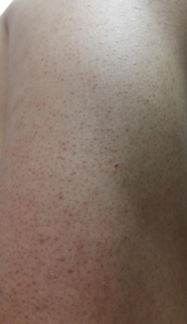 去鸡皮疙瘩毛囊的小妙招