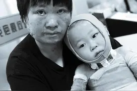 农村3岁烧伤小女孩的不幸与幸运，舅舅 奶奶 爸爸先后为其割皮救伤图片