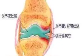 呵护关节 畅享人生 | 给您说说膝关节骨性关节炎治疗方法图片