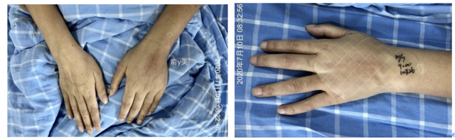 静脉输液部位选择不简单，一不小心竟“误入歧途”