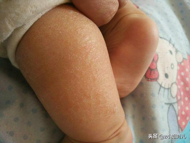 婴儿大腿鸡皮疙瘩
