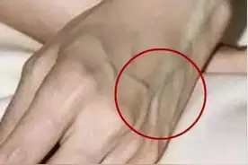 身体上出现青筋那么这几种疾病要注意了图片