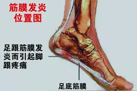 脚后跟为什么一踩地就疼？图片
