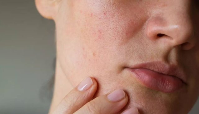 鐨偆灞忛殰鍙楁崯鎬庝箞鍔烇紵鎶よ偆鍋氬ソ杩欏嚑姝ユ槸鍏抽敭锛屽潥鎸佹墠鏈夋晥鍝? onerror=