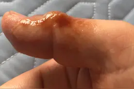 浅二度烧伤恢复时间 体验图片