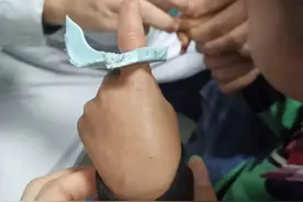 小孩子将手指头伸进凳子洞被卡到肿胀发紫，专家：警惕这些地方图片