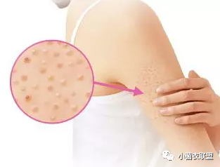 腿上毛囊炎导致鸡皮肤厉害