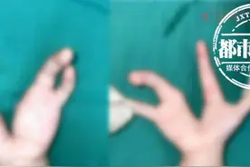 惊了！1岁半女童双手酷似“龙虾钳子”，医生：发病率万分之一图片