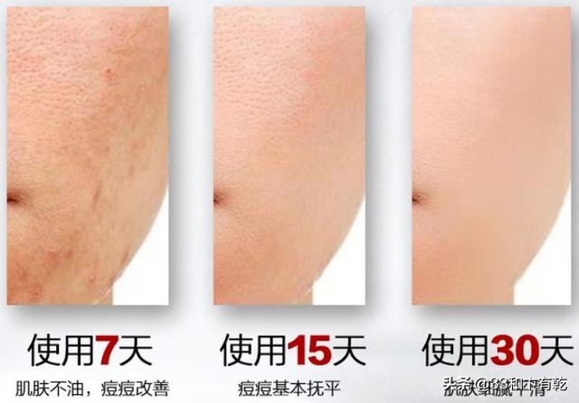 火爆INS的芝士皂，洗脸就像敷面膜，痘痘，黑头，螨虫全都消失了