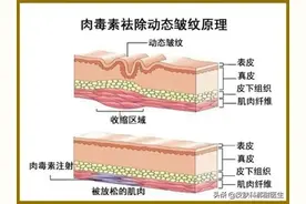 爱笑的女明星都没有鱼尾纹，解决“纹题”的秘密就在这里图片