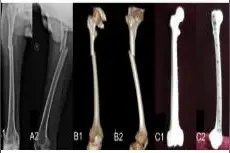 3D打印模拟手术联合定制钢板固定治疗小儿麻痹后遗症股骨干骨折图片