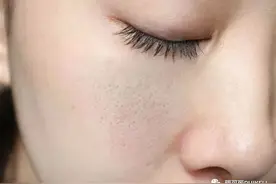 你的毛孔为什么会粗大图片