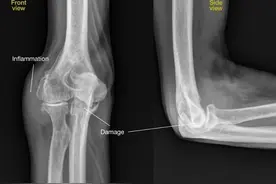 胳膊肘旋转、屈伸越来越困难，五指没劲，筷子用不了，是什么疾病图片