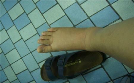 由于腹围的增加,腹水把腹腔的容积占据了过后就会产生腹胀,甚至由于