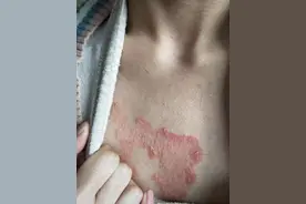 牛皮癣2年余，调体质，不治皮而皮自愈图片