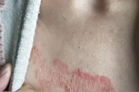 牛皮癣2年余，调体质，不治皮而皮自愈图片