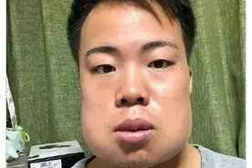 千万不要一次性拔掉四颗智齿！哈哈哈哈哈xswl！！图片