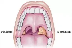 杭州9岁小男孩打呼噜长达五年，大部分家长不知道这里面的危害图片