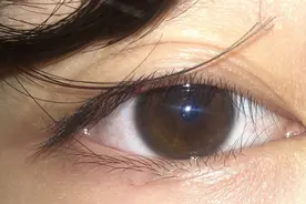 想做眼综合，不知道自己适合哪种双眼皮款式呢？有哪几种？图片