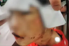 4岁女童疑遭继母虐待致浑身是伤，医院：女童昏迷不醒 多器官衰竭图片