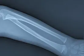 骨裂严重吗？骨裂造成的5大危害，不可轻视图片