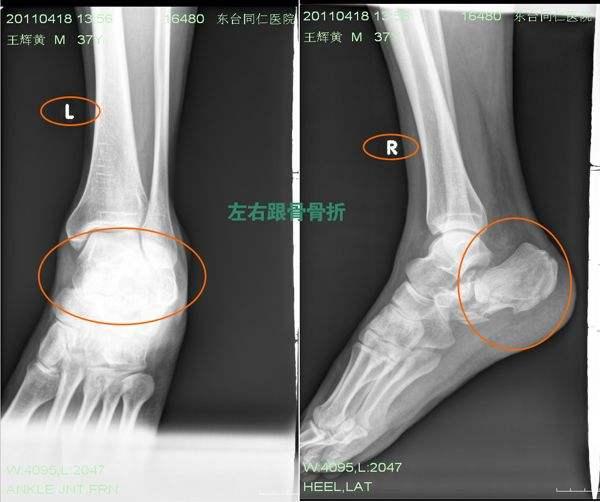 脚跟骨骨折后多长时间能走路,如何做好康复训练.