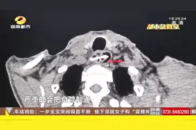 男子误吞鸭骨戳破食管，险些致命，手术成功取出4.5公分鸭骨视频封面
