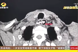 男子误吞鸭骨戳破食管，险些致命，手术成功取出4.5公分鸭骨视频封面