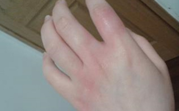 红霉素软膏可以治毛周角化症